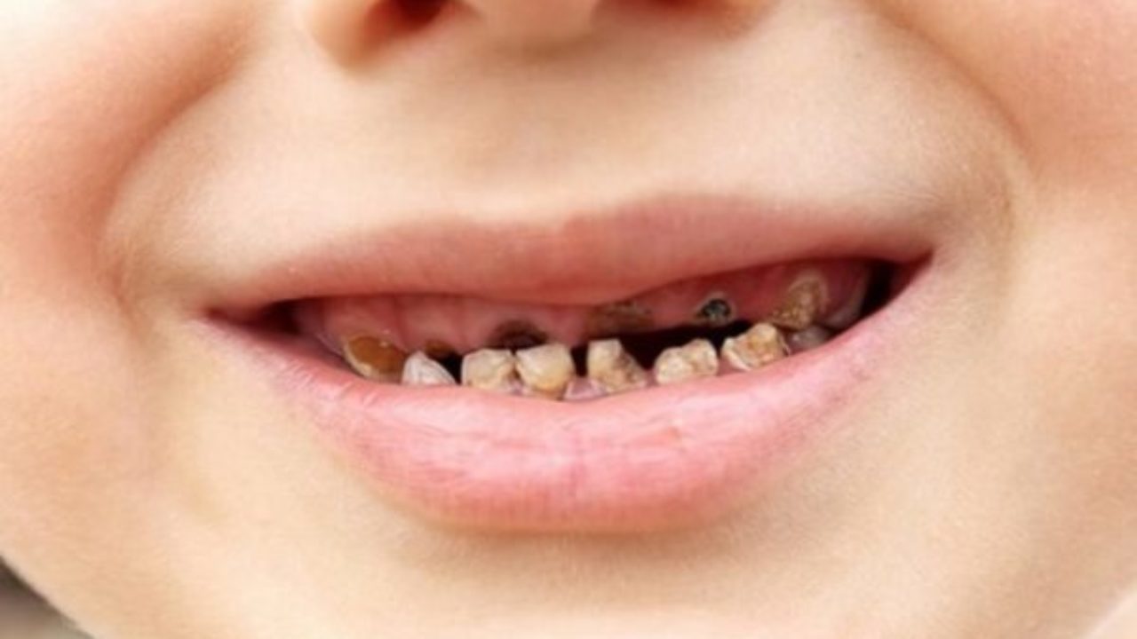 răng