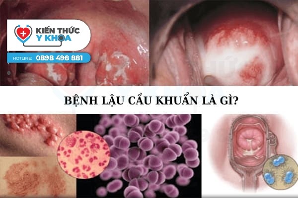 Chữa bệnh lậu hiệu quả tại TP Thanh Hóa 2020